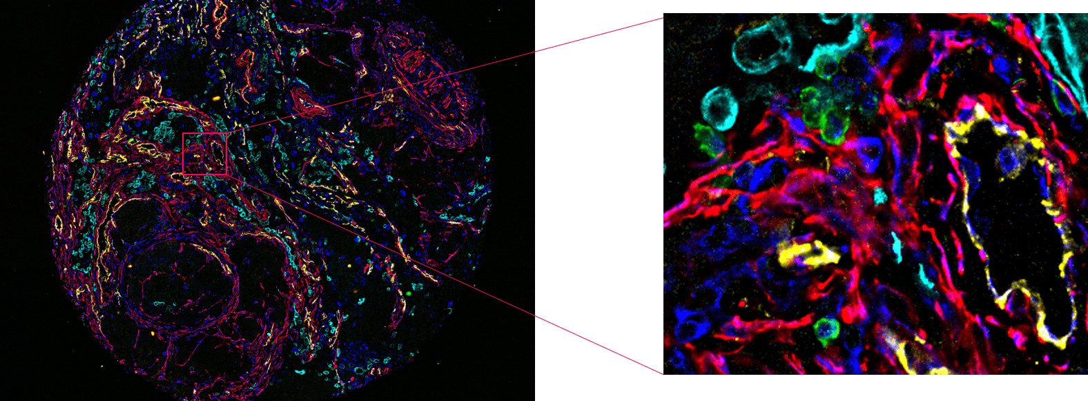 An FFPE human lung cancer tissue microarray core imaged with CODEX. (Red-SMA, Green-CD8, Blue-Vimentin, Cyan-Cytokeratin7/17, Yellow-CD31.)
