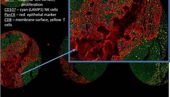 tonsil-tma-image